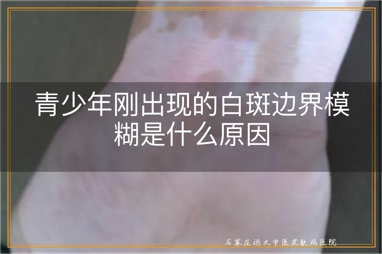 青少年刚出现的白斑边界模糊是什么原因
