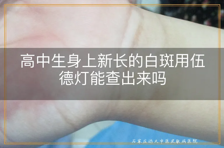 高中生身上新长的白斑用伍德灯能查出来吗