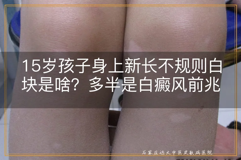 15岁孩子身上新长不规则白块是啥？多半是白癜风前兆