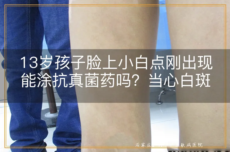 13岁孩子脸上小白点刚出现能涂抗真菌药吗？当心白斑误判