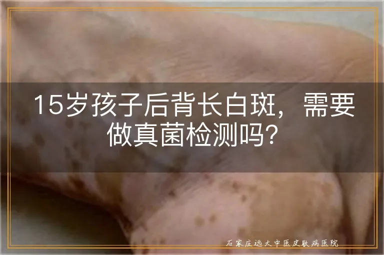 15岁孩子后背长白斑，需要做真菌检测吗？