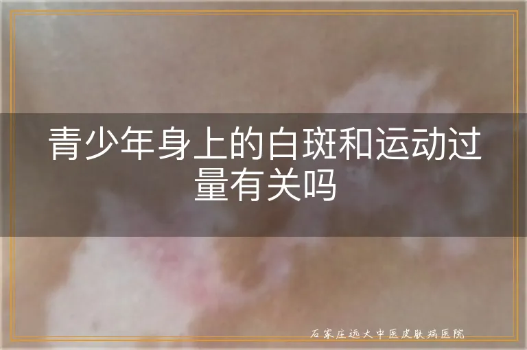 青少年身上的白斑和运动过量有关吗