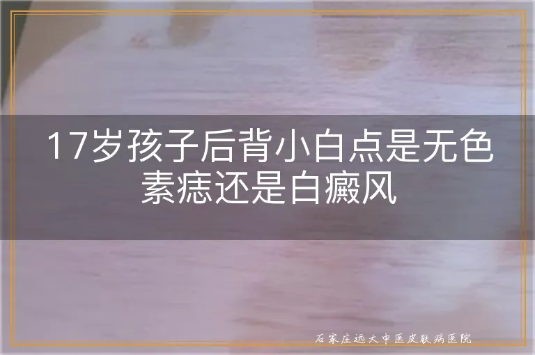 17岁孩子后背小白点是无色素痣还是白癜风