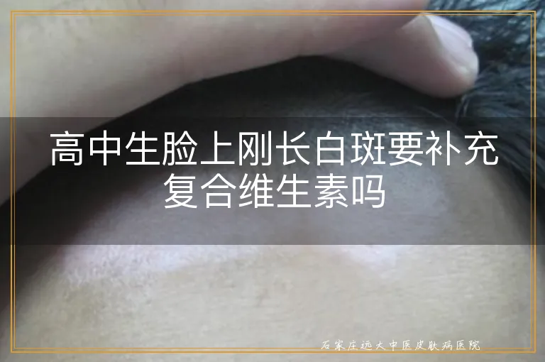 高中生脸上刚长白斑要补充复合维生素吗