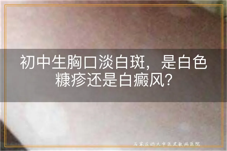 初中生胸口淡白斑，是白色糠疹还是白癜风？