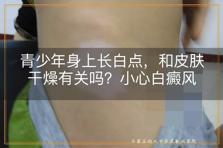 青少年身上长白点,和皮肤干燥有关吗?小心白癜风