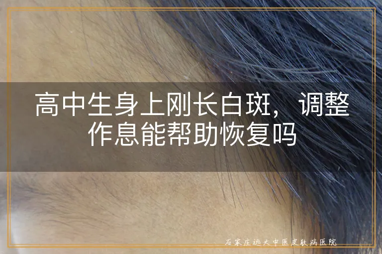 高中生身上刚长白斑,调整作息能帮助恢复吗