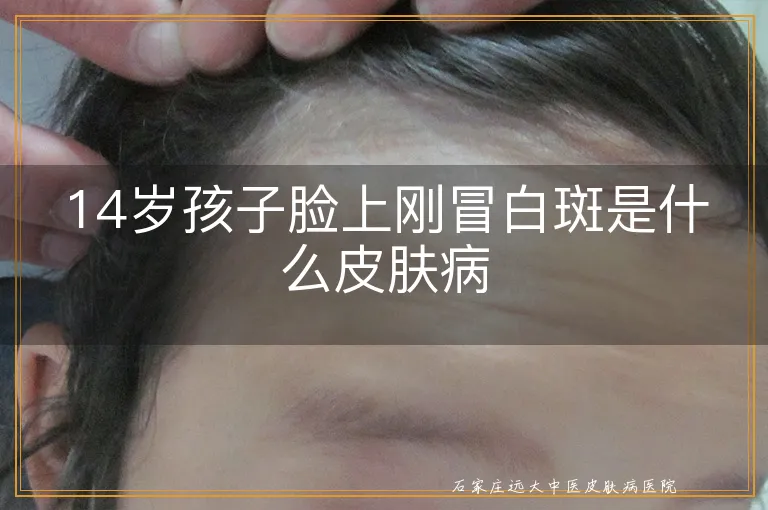 14岁孩子脸上刚冒白斑是什么皮肤病