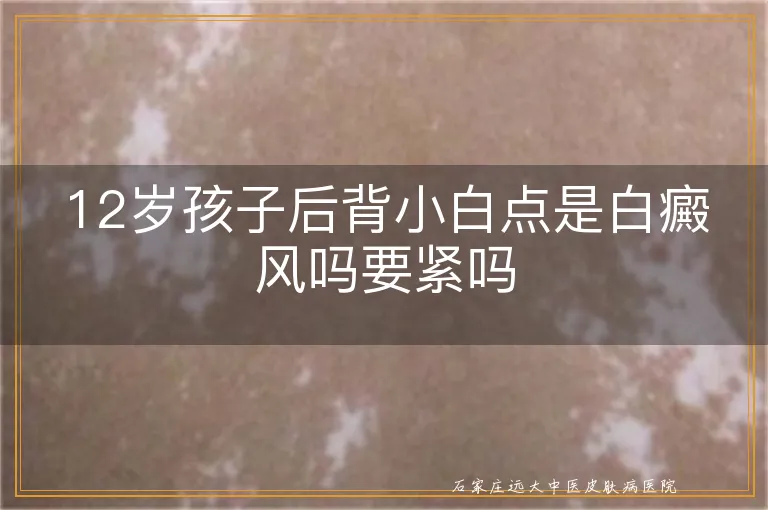 12岁孩子后背小白点是白癜风吗要紧吗