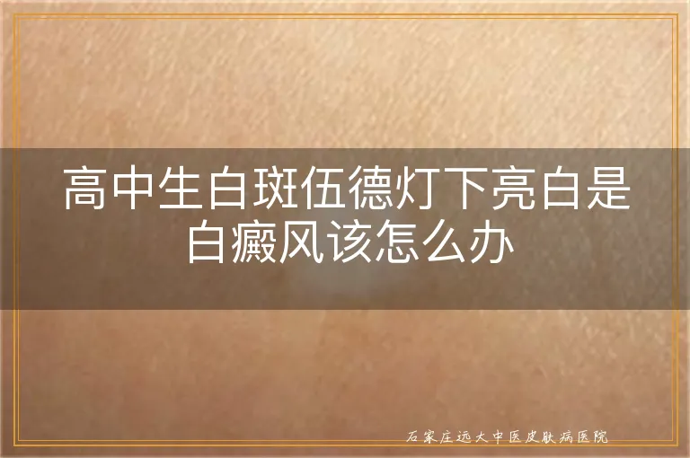高中生白斑伍德灯下亮白是白癜风该怎么办