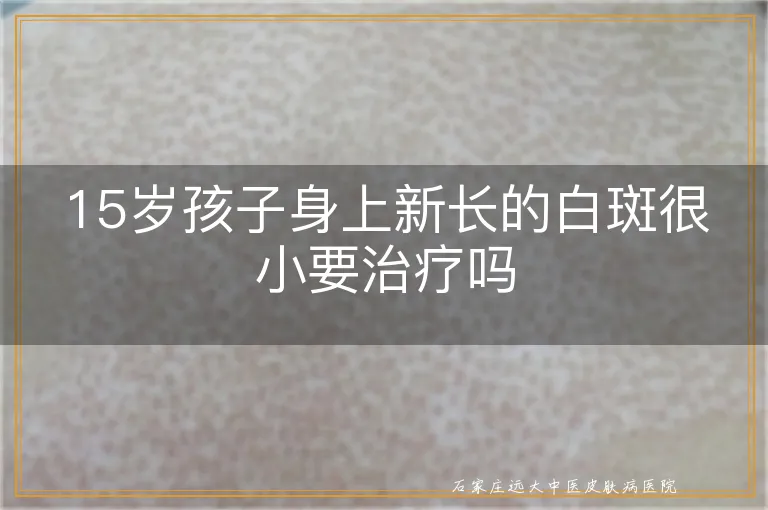 15岁孩子身上新长的白斑很小要治疗吗