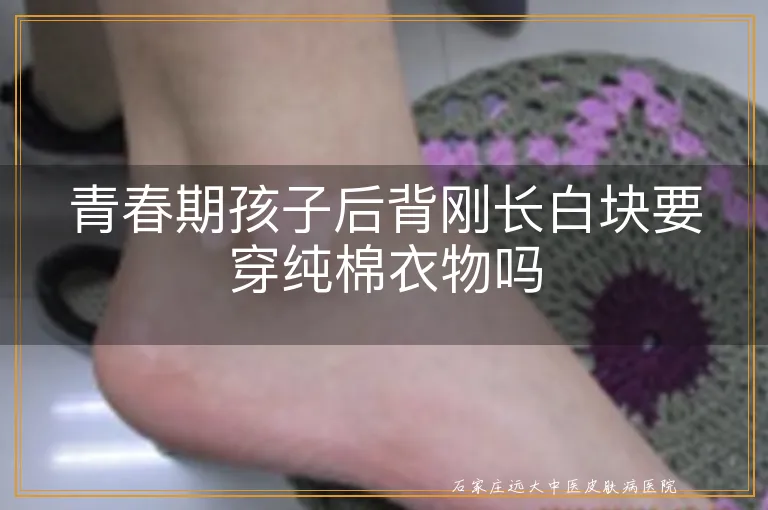 青春期孩子后背刚长白块要穿纯棉衣物吗