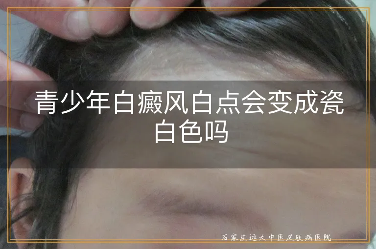 青少年白癜风白点会变成瓷白色吗