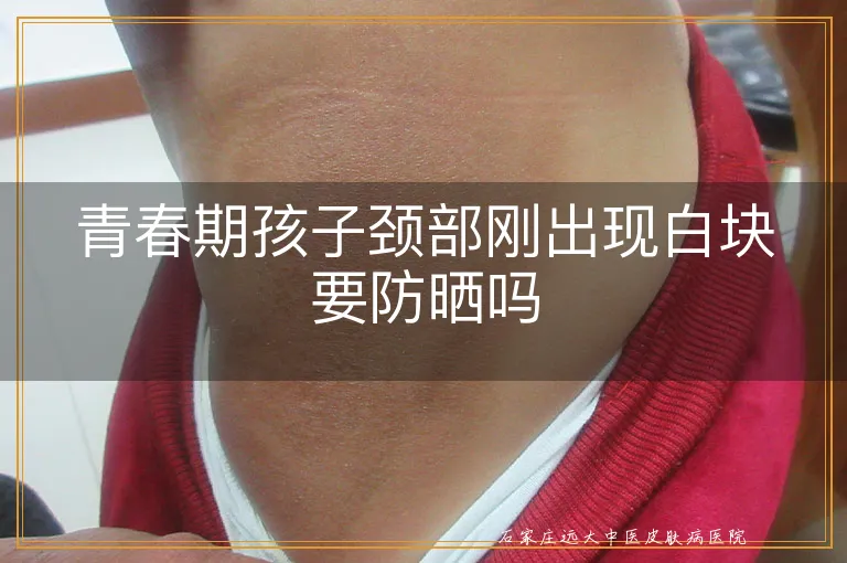 青春期孩子颈部刚出现白块要防晒吗