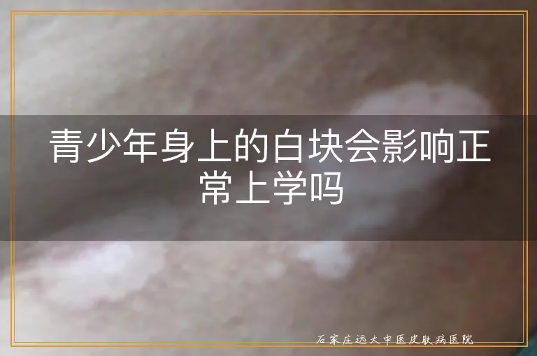 青少年身上的白块会影响正常上学吗