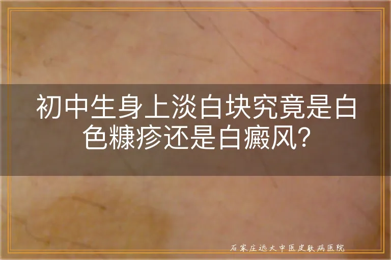 初中生身上淡白块究竟是白色糠疹还是白癜风？
