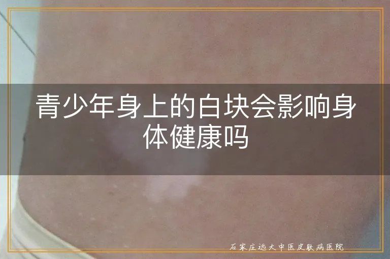青少年身上的白块会影响身体健康吗