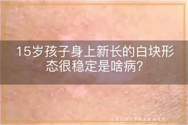 15岁孩子身上新长的白块形态很稳定是啥病？