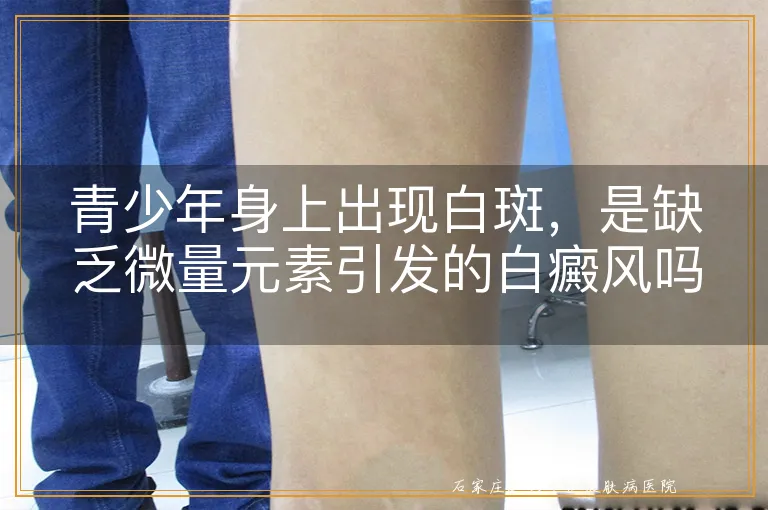 青少年身上出现白斑,是缺乏微量元素引发的白癜风吗