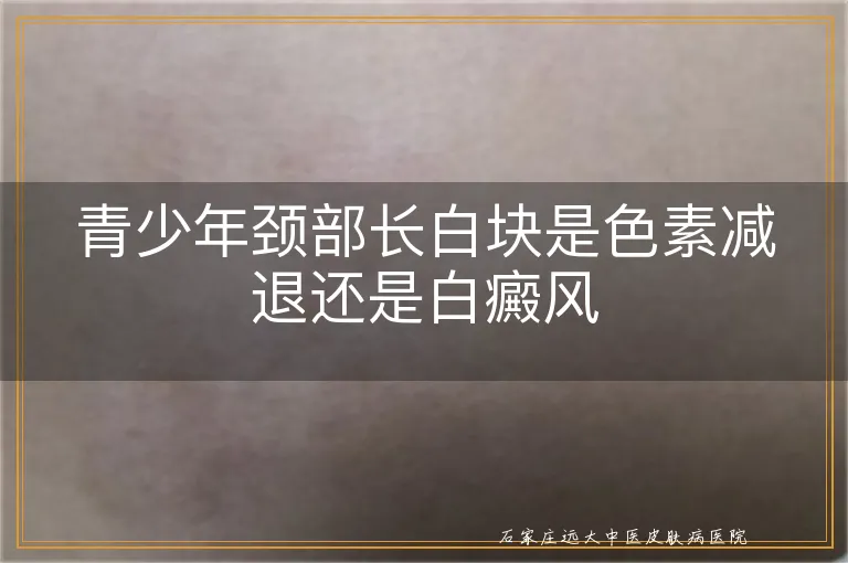 青少年颈部长白块是色素减退还是白癜风