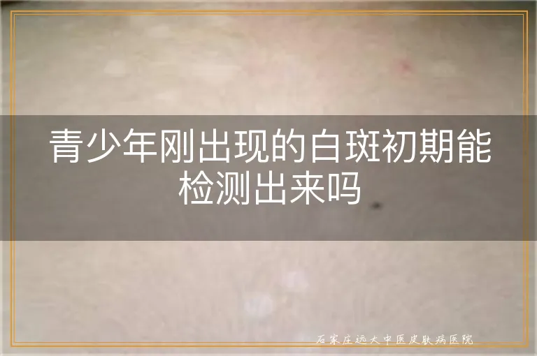 青少年刚出现的白斑初期能检测出来吗