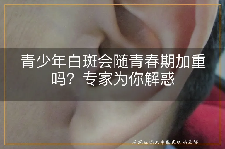 青少年白斑会随青春期加重吗?专家为你解惑