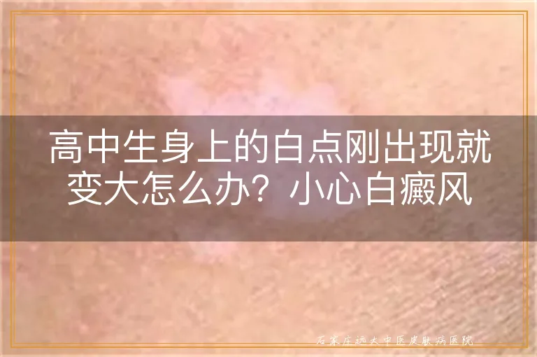 高中生身上的白点刚出现就变大怎么办？小心白癜风