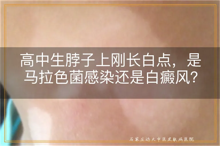 高中生脖子上刚长白点，是马拉色菌感染还是白癜风？