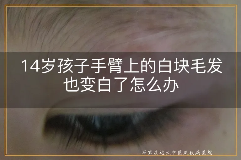 14岁孩子手臂上的白块毛发也变白了怎么办