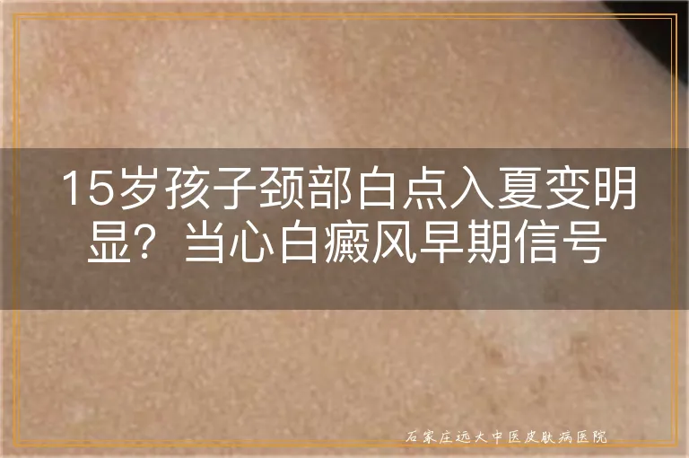 15岁孩子颈部白点入夏变明显？当心白癜风早期信号