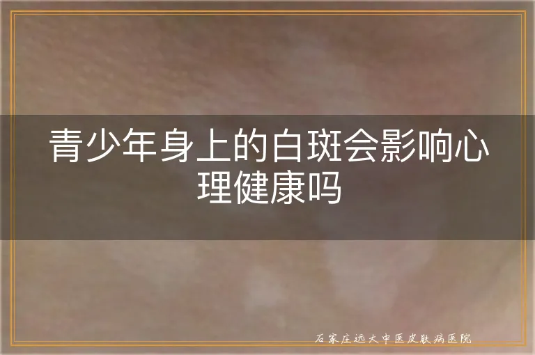 青少年身上的白斑会影响心理健康吗