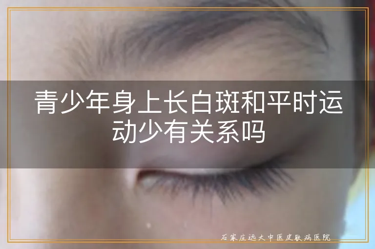 青少年身上长白斑和平时运动少有关系吗