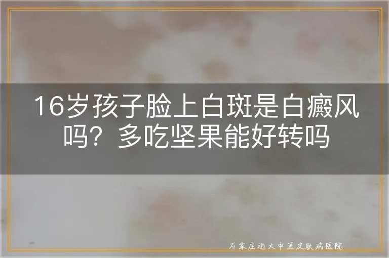 16岁孩子脸上白斑是白癜风吗？多吃坚果能好转吗