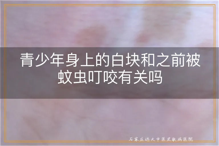 青少年身上的白块和之前被蚊虫叮咬有关吗