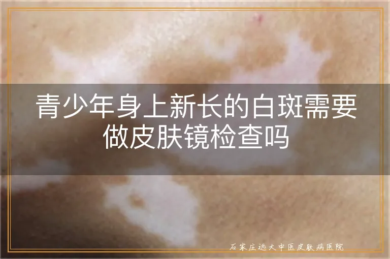 青少年身上新长的白斑需要做皮肤镜检查吗