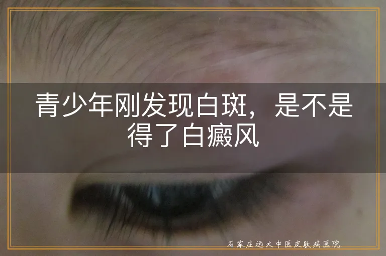 青少年刚发现白斑,是不是得了白癜风