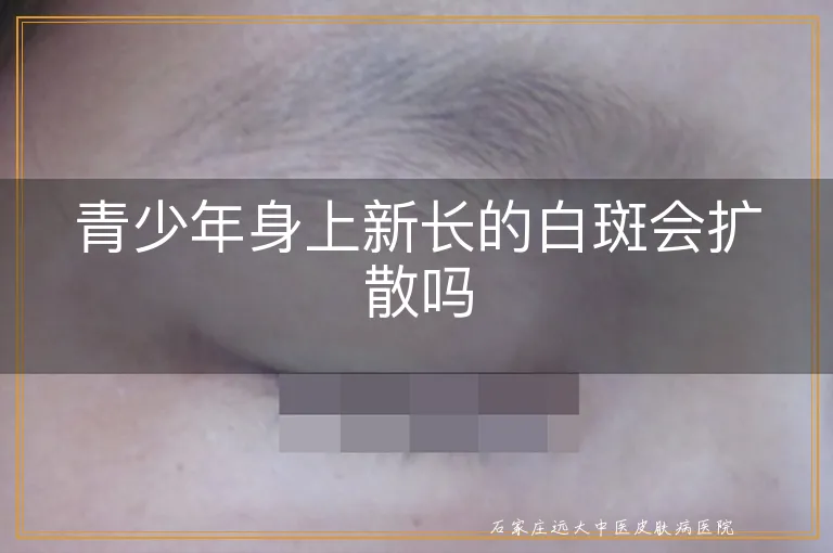 青少年身上新长的白斑会扩散吗