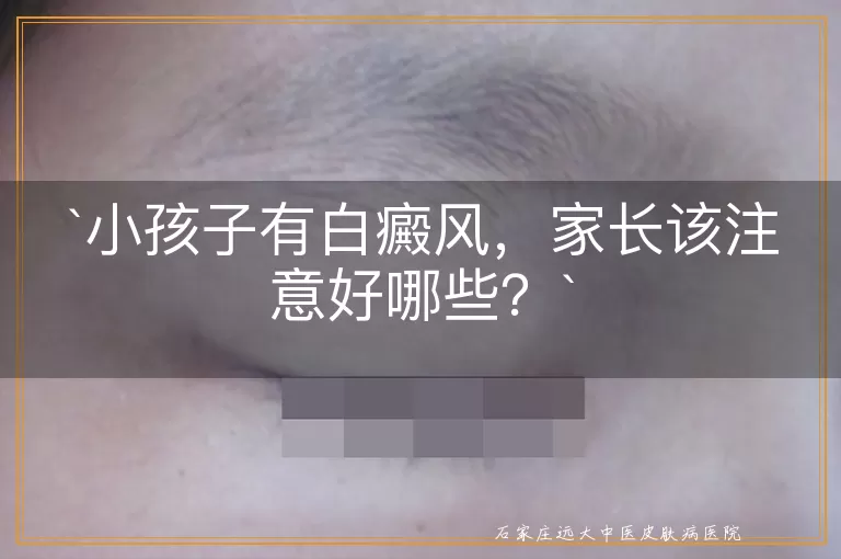 小孩子有白癜风，家长该注意好哪些？