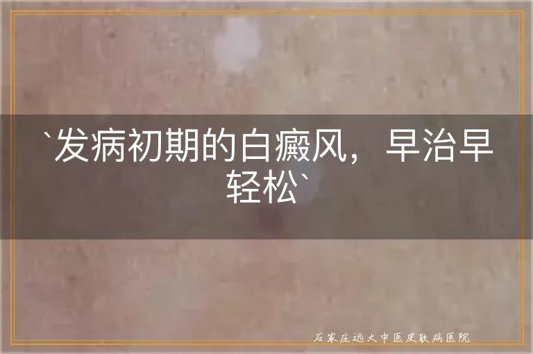 发病初期的白癜风，早治早轻松