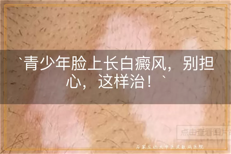 青少年脸上长白癜风，别担心，这样治！