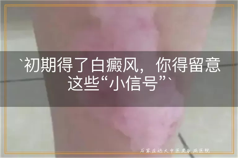 初期得了白癜风，你得留意这些“小信号”