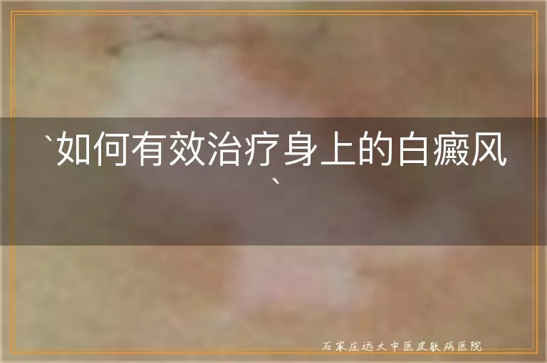 如何有效治疗身上的白癜风