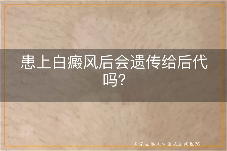 患上白癜风后会遗传给后代吗？