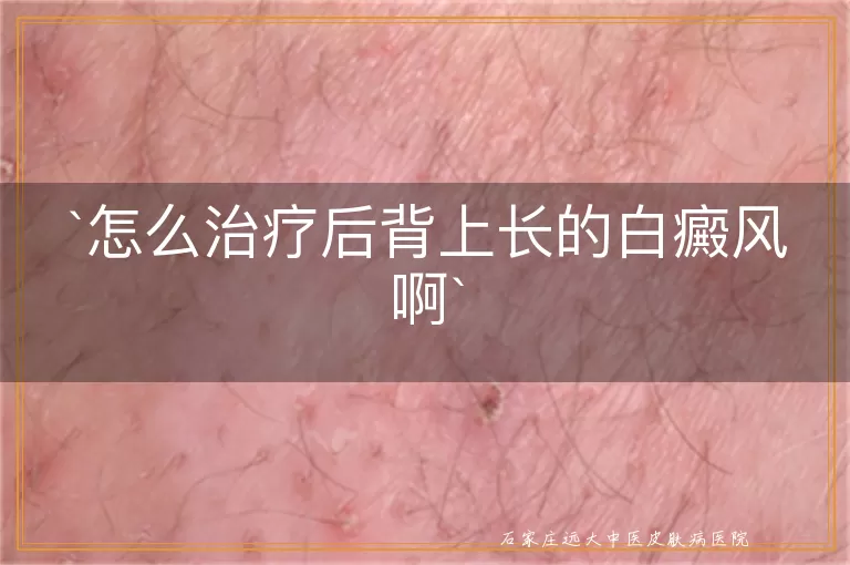 怎么治疗后背上长的白癜风啊