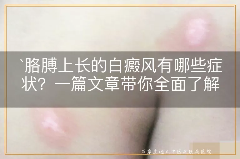 胳膊上长的白癜风有哪些症状？一篇文章带你全面了解