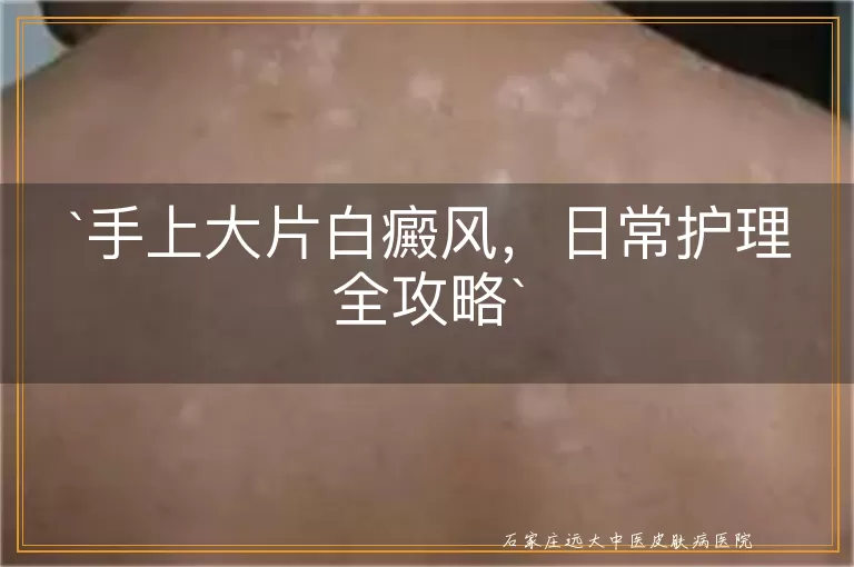 手上大片白癜风，日常护理全攻略