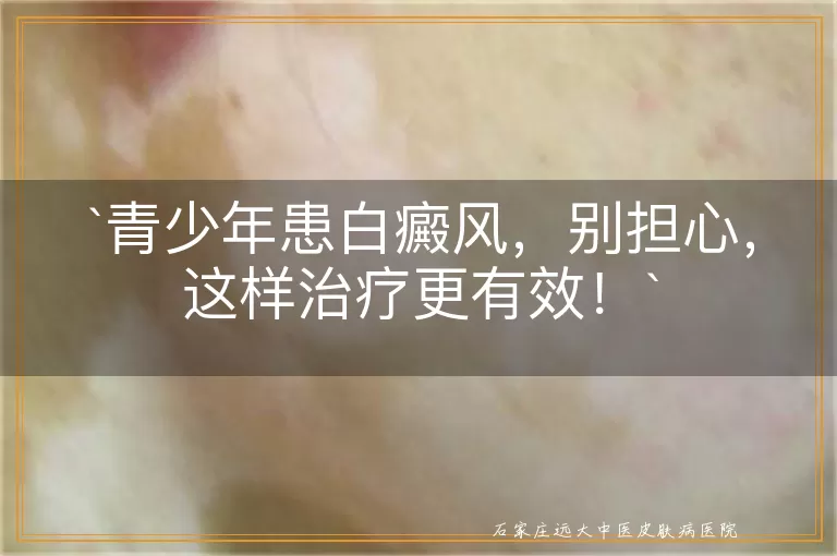 青少年患白癜风，别担心，这样治疗更有效！