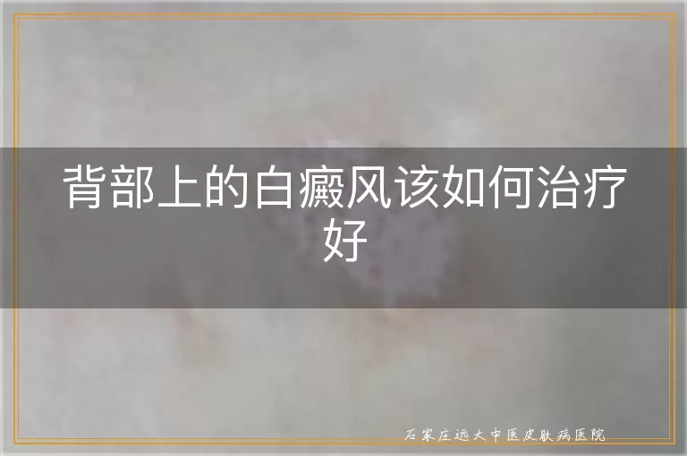 背部上的白癜风该如何治疗好