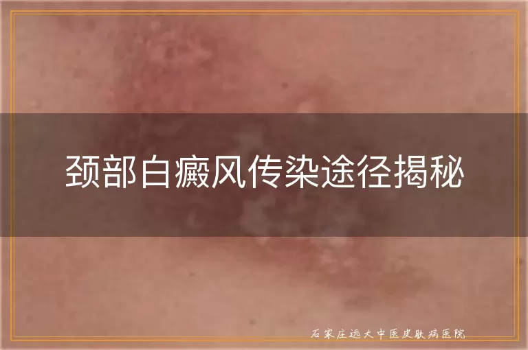 颈部白癜风传染途径揭秘