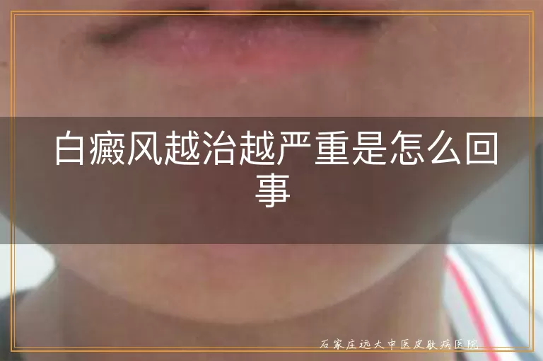 白癜风越治越严重是怎么回事